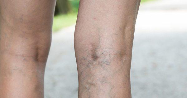 Varicose Veins Treatment: A Q&A with UCSF Interventional Radiologists -  UCSF Radiology