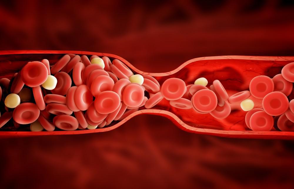 Blood clots: What you need to know
