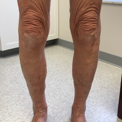 Varicose Veins Before & After Patient #345