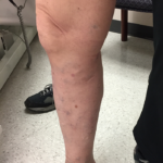 Varicose Veins Before & After Patient #329