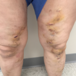 Varicose Veins Before & After Patient #337