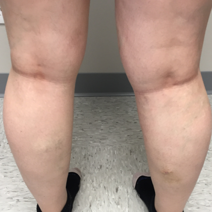 Varicose Veins Before & After Patient #337