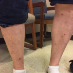 Varicose Veins Before & After Patient #355