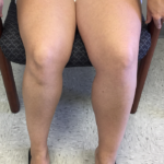 Varicose Veins Before & After Patient #326