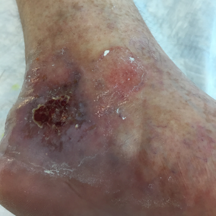 Venous Ulcers Before & After Patient #349