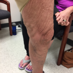Varicose Veins Before & After Patient #345