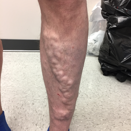 Varicose Veins Before & After Patient #355