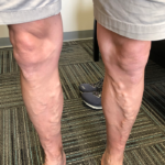 Varicose Veins Before & After Patient #352