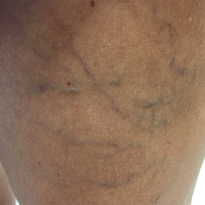 Vein Sclerotherapy Before & After Patient #317