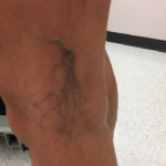 Varicose Veins Before & After Patient #317
