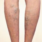 Varicose Veins Before & After Patient #273