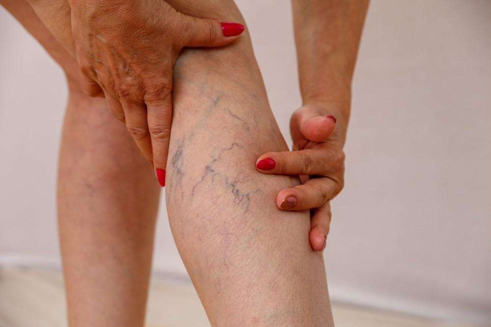 Top Tips for Preventing Varicose Veins
