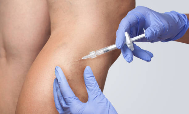 How Sclerotherapy Works
