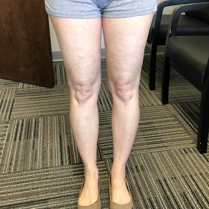 What is Recovery like Following sclerotherapy?