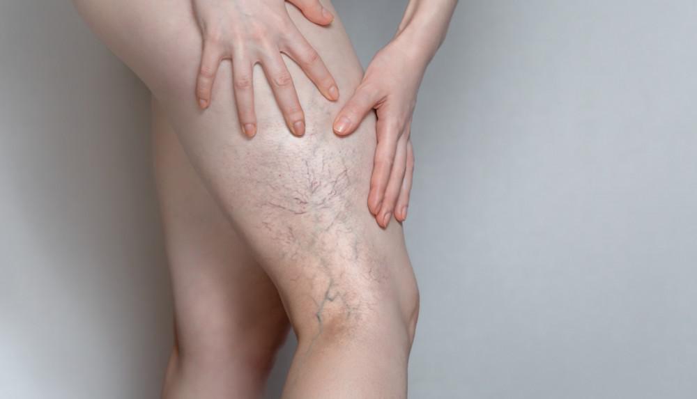 Are Your Veins Than a Cosmetic Issue? | Premier Vein