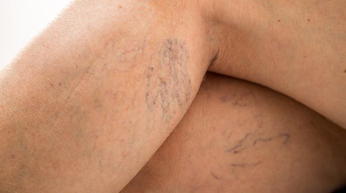 How Your Weight Affects Your Veins