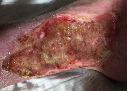 Venous Ulcers Before & After Patient #713