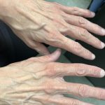 Hand Rejuvenation Before & After Patient #858