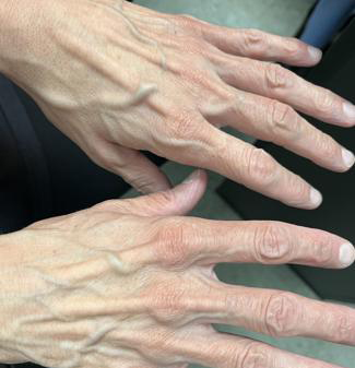Hand Rejuvenation Before & After Patient #858