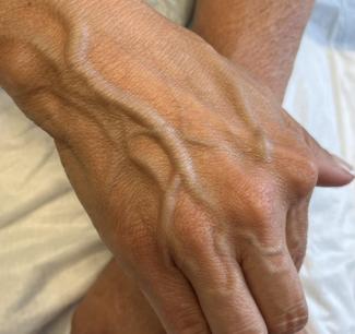 Hand Rejuvenation Before & After Patient #863