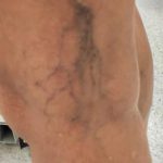 Vein Sclerotherapy Before & After Patient #882