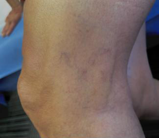 Vein Sclerotherapy Before & After Patient #882