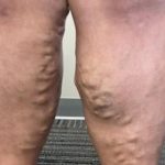 Varicose Veins Before & After Patient #885