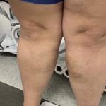 Varicose Veins Before & After Patient #885